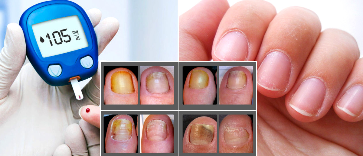 Finger Nails Can Be Diabetes Tell Tale Sign Health And Lifestyle
